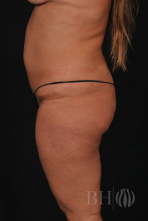 Arm Lift Before & After